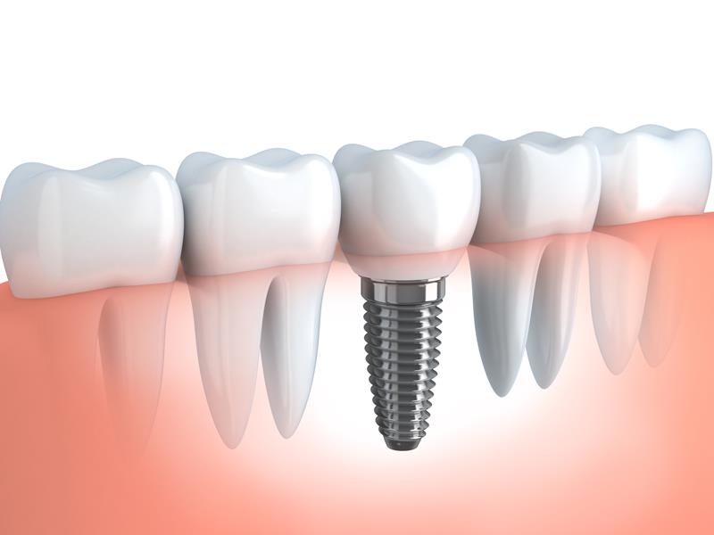 Dental Implants Macclenny, FL