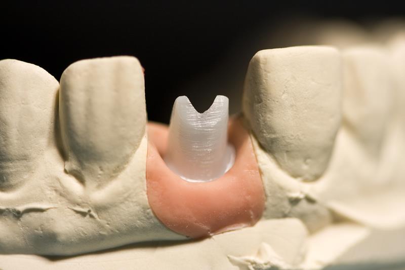 Implant Restoration Macclenny, FL